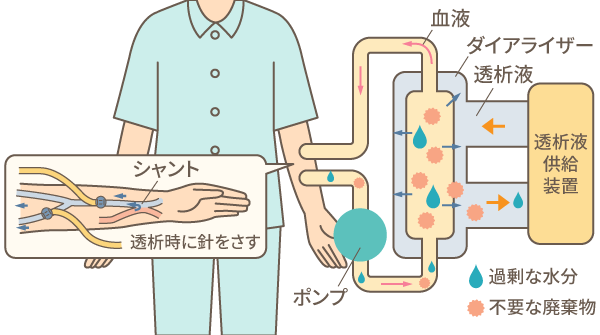 図：血液透析のしくみ