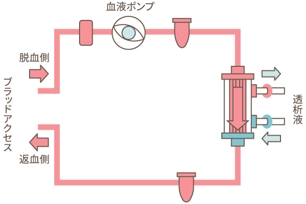 図：血液透析（HD）