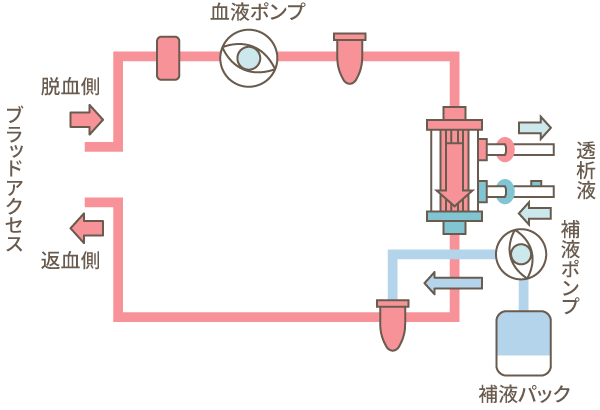 図：血液透析（HF）