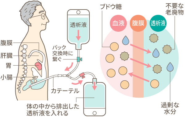 図：腹膜透析のしくみ